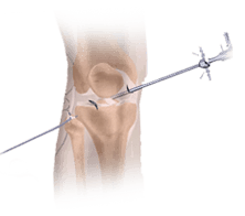 Sports/Joint Replacement